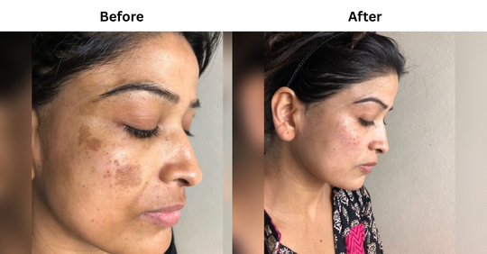 Hyperpigmentation & Skin Tan