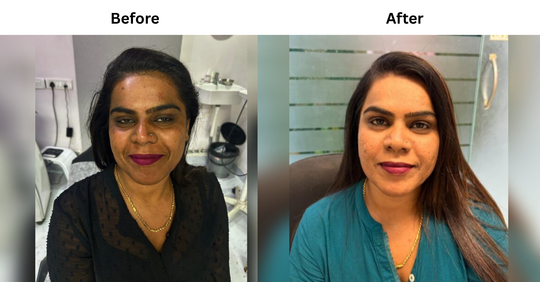 POST-ACNE MARKS & UNEVEN SKIN TEXTURE