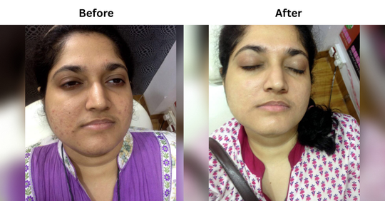 POST-ACNE MARKS & UNEVEN SKIN TONE