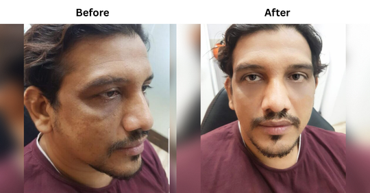 MILD PIGMENTATION & LOSS OF SKIN RADIANCE