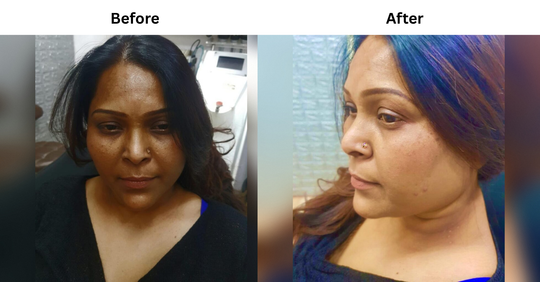 DULL SKIN, PIGMENTATION & UNEVEN SKIN TONE