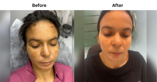 Hyperpigmentation & Skin Tan