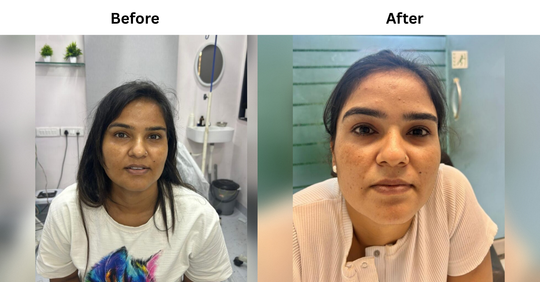 Hyperpigmentation & Skin Tan