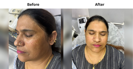 Hyperpigmentation & Skin Tan