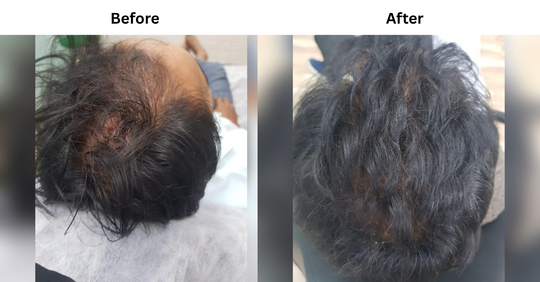 RECEDING HAIRLINE & TEMPORAL HAIR THINNING