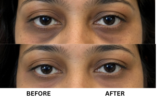 UNDER-EYE PIGMENTATION & UNEVEN SKIN TONE