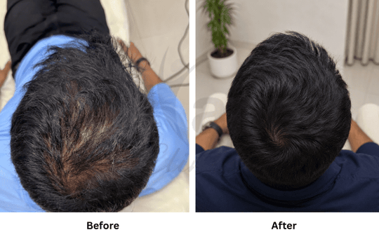 CROWN HAIR THINNING & SCALP VISIBILITY