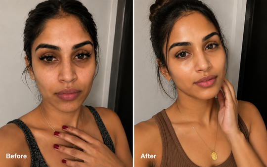 Dark Circles & Under-Eye Fatigue